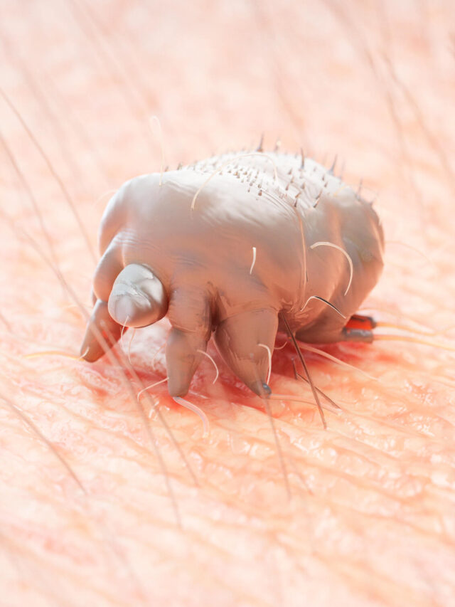 Scabies Mites: The Itchy Truth